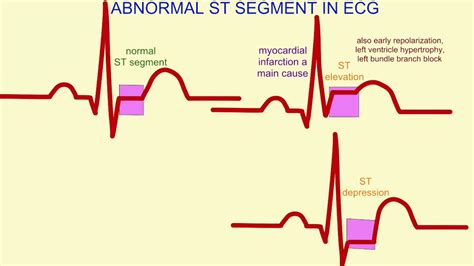 bad ekg readings|Abnormal EKG: What It Means and Treatment Options .